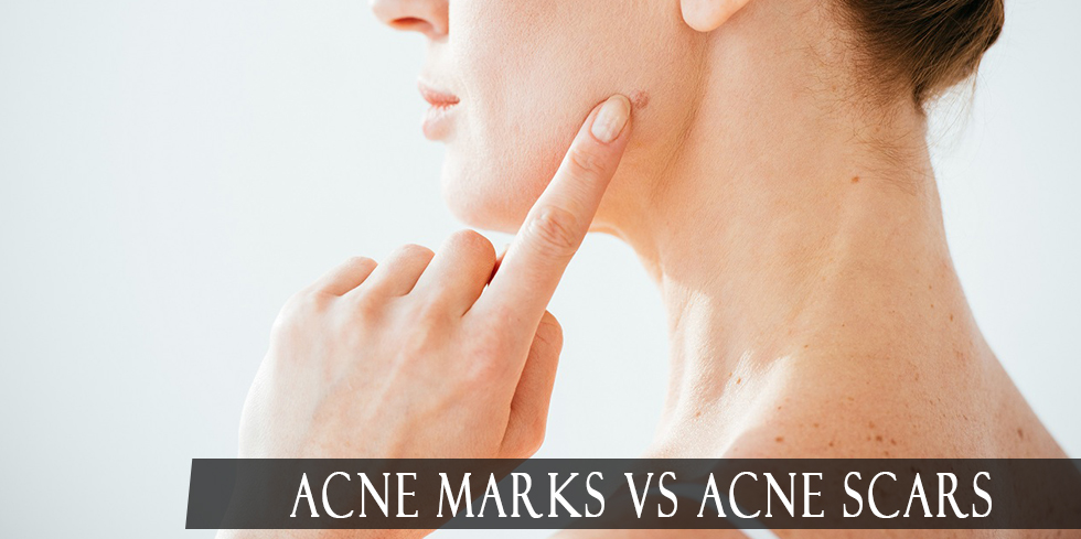 Acne marks and scars