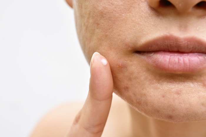 Woman with acne applying cream