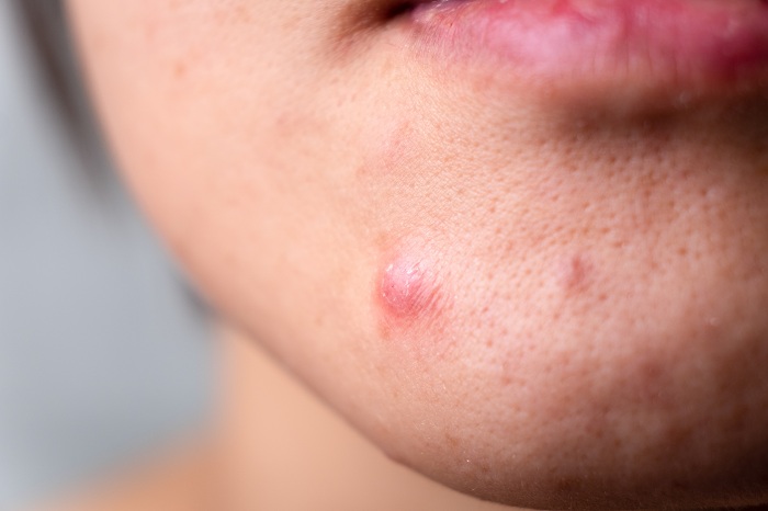 acne and skin problems