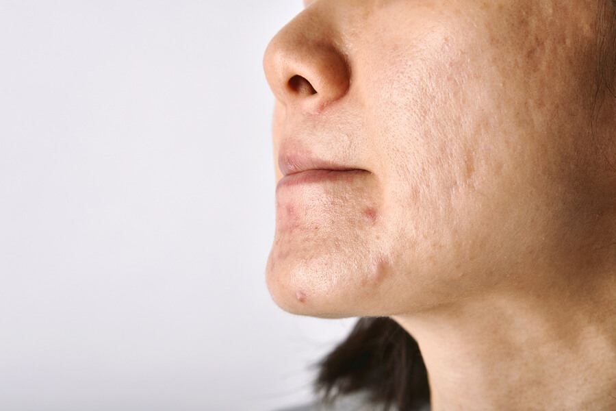 acne disease skin problem