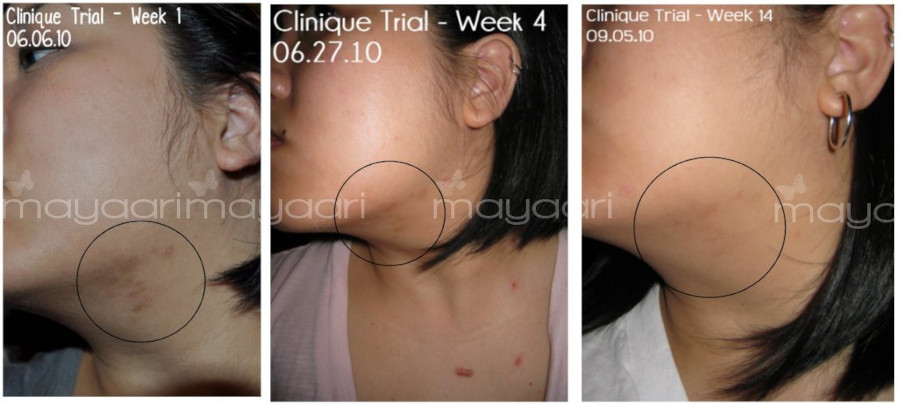 Clinique Even Better Dark Spot Corrector before and after