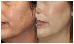 Before and After Microderm MD